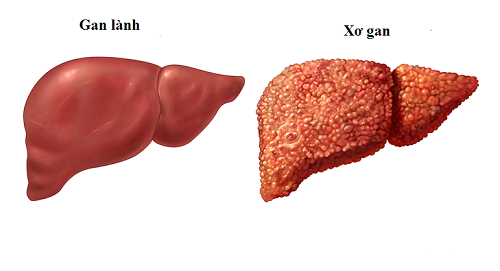 
Hình ảnh lá gan bị xơ và gan thường.
