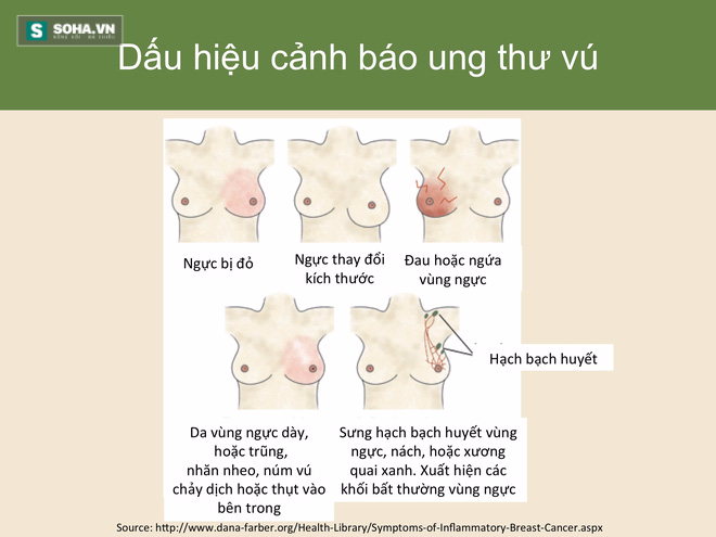 Hình 5: Các dấu hiệu cảnh báo ung thư vú.