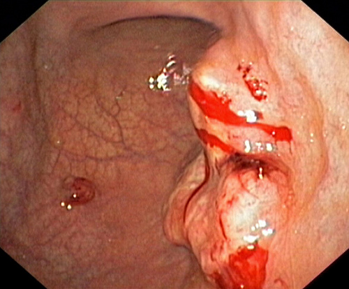 
Hình ảnh khối u trong dạ dày
