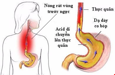 
Dấu hiệu đau họng, khàn tiếng do trào ngược dạ dày rất dễ nhầm với bệnh đường hô hấp.
