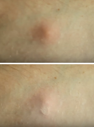
Trước và sau khi áp thìa lên vết muỗi đốt 2-3.
