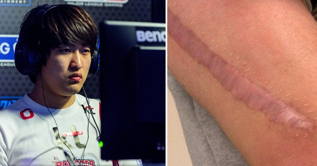 Với người chơi Lee Young-ho, game thủ bộ môn StarCraft thì vết sẹo phẫu thuật ấy lại là “tấm huân chương danh dự” của anh.