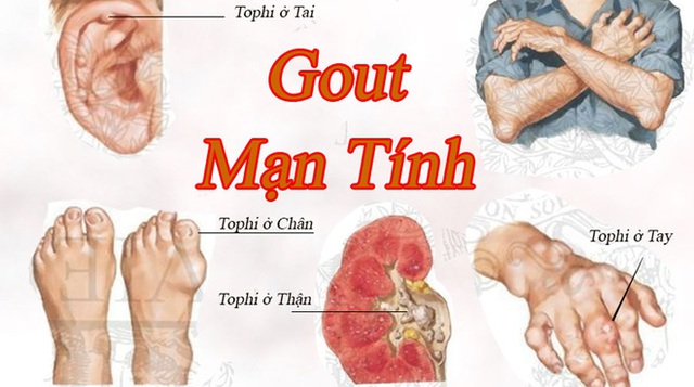 
Ăn cá lúc đói bụng dễ bị mắc bệnh gút (Ảnh minh họa)
