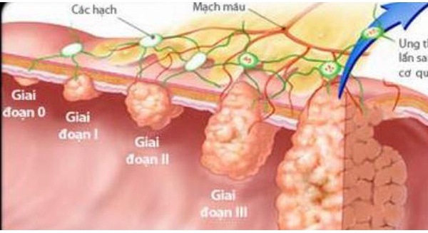 B&#225;c sĩ khoa Ti&#234;u h&#243;a &quot;vạch mặt&quot; c&#225;c thủ phạm g&#226;y ung thư dạ d&#224;y