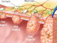 Bác sĩ khoa Tiêu hóa "vạch mặt" các thủ phạm gây ung thư dạ dày Bác sĩ khoa Tiêu hóa "vạch mặt" các thủ phạm gây ung thư dạ dày