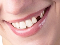 Làm Sao Để Răng Vĩnh Viễn Mọc Lại? Làm Sao Để Răng Vĩnh Viễn Mọc Lại?