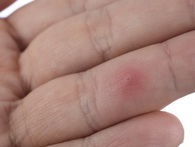 Đừng coi thường khi bị dằm đâm vào tay, hãy tìm cách lấy ra ngay để tránh hậu họa nguy hiểm Đừng coi thường khi bị dằm đâm vào tay, hãy tìm cách lấy ra ngay để tránh hậu họa nguy hiểm