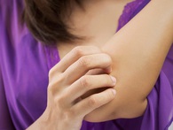 Vì sao bạn bị muỗi đốt nhiều hơn những người khác? Vì sao bạn bị muỗi đốt nhiều hơn những người khác?