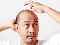 Đàn ông có 2 dấu hiệu này không cần chờ tới 50 tuổi cũng hói đầu? Đàn ông có 2 dấu hiệu này không cần chờ tới 50 tuổi cũng hói đầu?