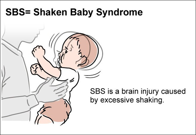 Bé 5 tháng tử vong sau 3 cơn đau tim và 2 lần đột quỵ: Cảnh báo cha mẹ tuyệt đối không làm hành động này với trẻ - Ảnh 2. Bé 5 tháng tử vong sau 3 cơn đau tim và 2 lần đột quỵ: Cảnh báo cha mẹ tuyệt đối không làm hành động này với trẻ - Ảnh 2.