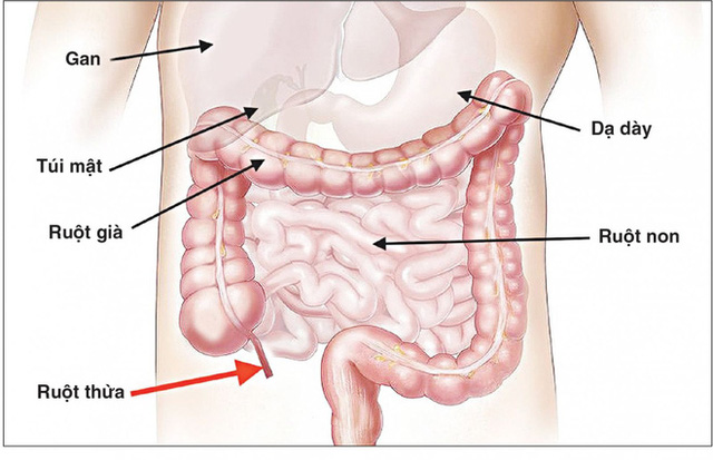  Đau bụng kèm sốt, chán ăn: Cẩn thận với căn bệnh có thời gian vàng cấp cứu chỉ 6 giờ, để lâu nhiều biến chứng  - Ảnh 1.