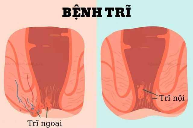 Bác sĩ BV Việt Đức cảnh báo về căn bệnh khó nói, ám ảnh cuộc sống của hơn 50% dân số Việt Nam: Dân văn phòng và người trung niên càng dễ mắc - Ảnh 2. Bác sĩ BV Việt Đức cảnh báo về căn bệnh khó nói, ám ảnh cuộc sống của hơn 50% dân số Việt Nam: Dân văn phòng và người trung niên càng dễ mắc - Ảnh 2.