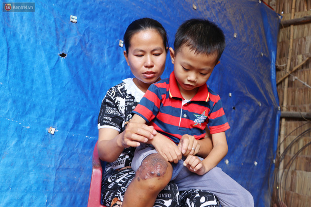 Lời khẩn cầu của bé trai 8 tuổi mắc bệnh lạ, phải cắt bỏ ruột: Mỗi lần chảy máu nó bắn ra ngoài, con sợ lắm… - Ảnh 1. Lời khẩn cầu của bé trai 8 tuổi mắc bệnh lạ, phải cắt bỏ ruột: Mỗi lần chảy máu nó bắn ra ngoài, con sợ lắm… - Ảnh 1.