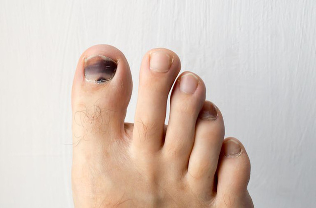  Móng chân chuyển màu đen có thể là nốt ruồi lành tính nhưng nhiều khi cũng là dấu hiệu của các bệnh, bao gồm cả ung thư  - Ảnh 1.
