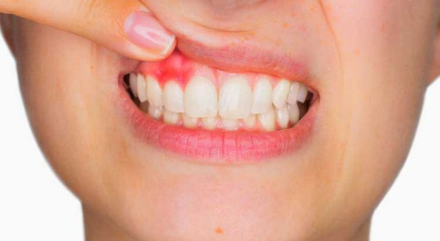 Khi bệnh gan trở thành ung thư, sẽ có 3 bất thường xuất hiện trên cơ thể - Ảnh 2. Khi bệnh gan trở thành ung thư, sẽ có 3 bất thường xuất hiện trên cơ thể - Ảnh 2.