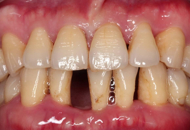  3 hiện tượng bất thường ở vùng răng miệng có thể giúp bạn phán đoán sớm nguy cơ mắc bệnh ung thư gan  - Ảnh 3.