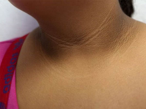 3 thay đổi trên cổ có thể là dấu hiệu sớm của bệnh ung thư mà bạn không nên chủ quan bỏ qua - Ảnh 1. 3 thay đổi trên cổ có thể là dấu hiệu sớm của bệnh ung thư mà bạn không nên chủ quan bỏ qua - Ảnh 1.