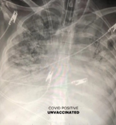  Ảnh chụp X-quang phổi cho thấy tác dụng tuyệt vời của vaccine Covid-19 - Ảnh 1.