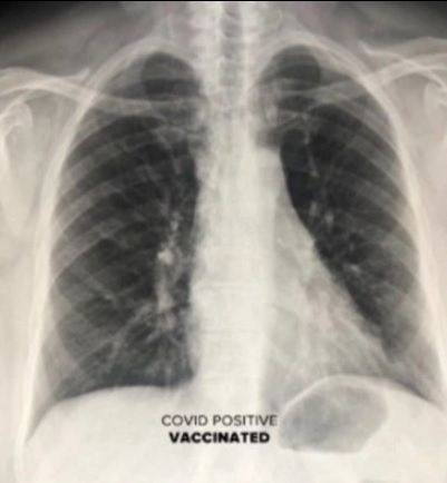  Ảnh chụp X-quang phổi cho thấy tác dụng tuyệt vời của vaccine Covid-19 - Ảnh 2.