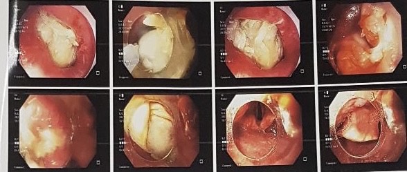 Hóc xương gà, nguyên nhân dẫn đến biến chứng chết người - Ảnh 1.