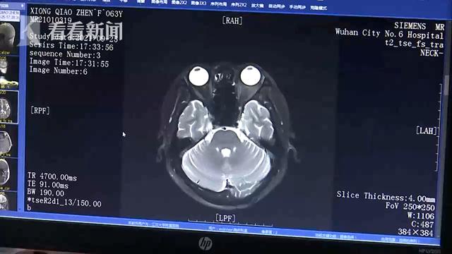 Người phụ nữ phát hiện khối u ác tính trong ống tai, bác sĩ cảnh báo thói quen ngoáy tai quá đà có thể kích hoạt tế bào ung thư - Ảnh 1. Người phụ nữ phát hiện khối u ác tính trong ống tai, bác sĩ cảnh báo thói quen ngoáy tai quá đà có thể kích hoạt tế bào ung thư - Ảnh 1.