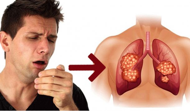 Thường xuyên xuất hiện 4 triệu chứng này thì có thể bạn đã bị ung thư phổi rồi, nhiều người chủ quan với dấu hiệu 3 khiến bệnh nặng thêm - Ảnh 2.