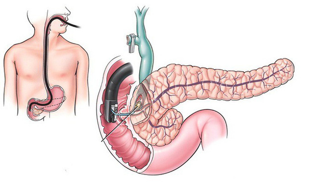  Căn bệnh ung thư có tỉ lệ mắc bệnh và tử vong cao bằng nhau: Cơ hội sống chỉ dài 4-7 tháng  - Ảnh 2.