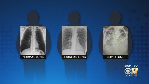 BS so sánh 3 lá phổi: Bệnh nhân Covid-19 có hậu quả tổn thương nghiêm trọng hơn, bị sẹo phổi - Ảnh 1.