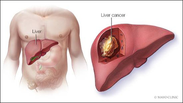  Đây là 4 lý do khiến bạn dễ bị ung thư gan: Cách phòng ngừa hiệu quả thật sự không khó - Ảnh 2.