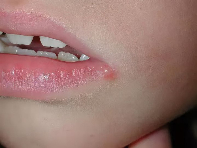 3 trẻ nhỏ chết não trong 2 tháng chỉ vì mụn nước ở khóe miệng, bác sĩ chỉ ra con đường lây nhiễm bệnh xuất phát từ hành động nhiều người vẫn làm - Ảnh 1. 3 trẻ nhỏ chết não trong 2 tháng chỉ vì mụn nước ở khóe miệng, bác sĩ chỉ ra con đường lây nhiễm bệnh xuất phát từ hành động nhiều người vẫn làm - Ảnh 1.