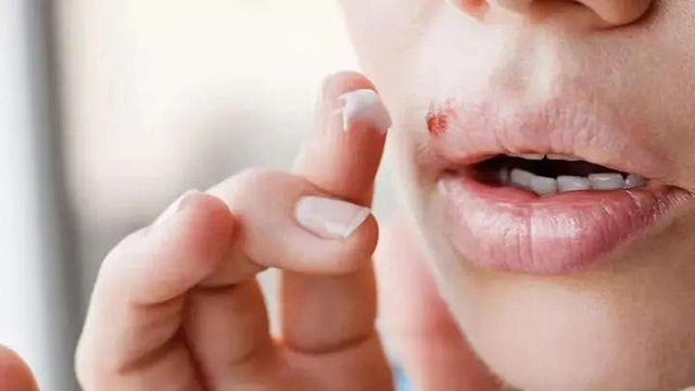3 trẻ nhỏ chết não trong 2 tháng chỉ vì mụn nước ở khóe miệng, bác sĩ chỉ ra con đường lây nhiễm bệnh xuất phát từ hành động nhiều người vẫn làm - Ảnh 3. 3 trẻ nhỏ chết não trong 2 tháng chỉ vì mụn nước ở khóe miệng, bác sĩ chỉ ra con đường lây nhiễm bệnh xuất phát từ hành động nhiều người vẫn làm - Ảnh 3.
