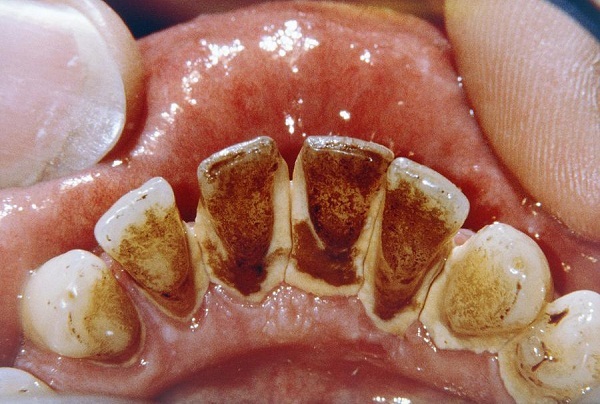 Chuyên gia chỉ ra cách ngăn ngừa virus xâm nhập răng miệng, trong mùa dịch COVID-19 người dân càng nên dắt túi - Ảnh 4.