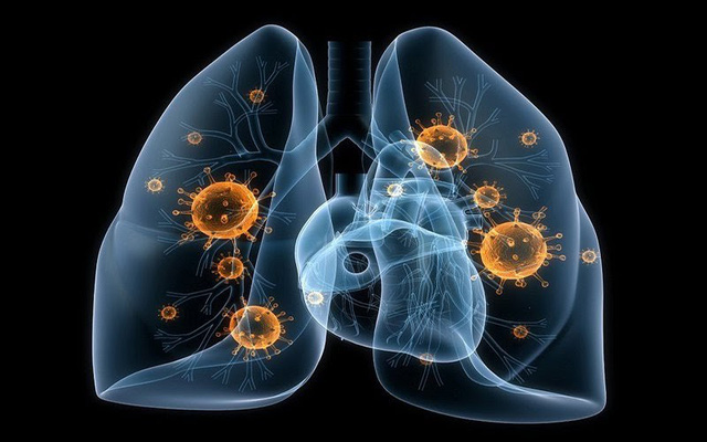 Căn bệnh được mệnh danh là “hố đen” hút hết sinh khí của phổi, nhiều người chủ quan bỏ lỡ giai đoạn vàng để rồi cơ thể sức tàn lực kiệt - Ảnh 2.