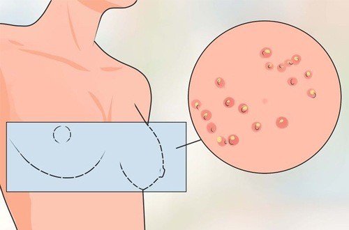 Khi thấy vùng da ngực xuất hiện những dấu hiệu này, hãy nghĩ ngay đến bệnh ung thư vú - Ảnh 2.