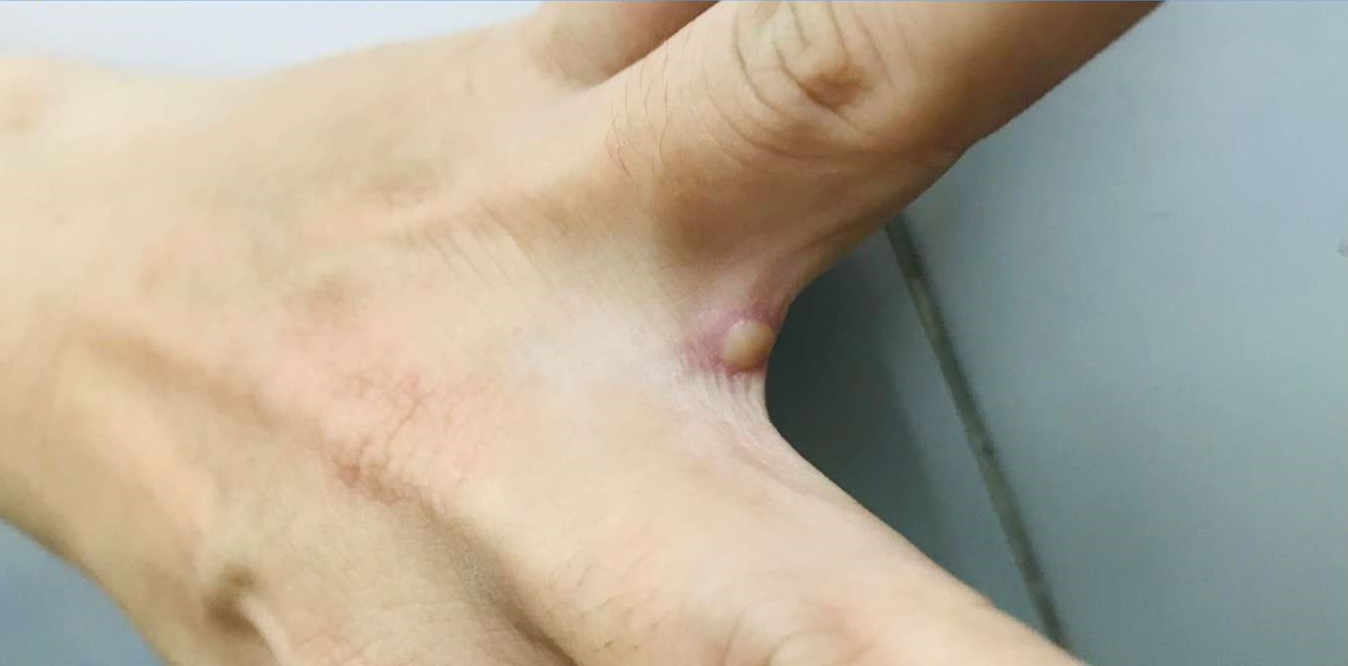 Công bố hình ảnh bóng nước ở bệnh nhân mắc đậu mùa khỉ giúp phân biệt với thủy đậu, chân tay miệng - Ảnh 2. Công bố hình ảnh bóng nước ở bệnh nhân mắc đậu mùa khỉ giúp phân biệt với thủy đậu, chân tay miệng - Ảnh 2.