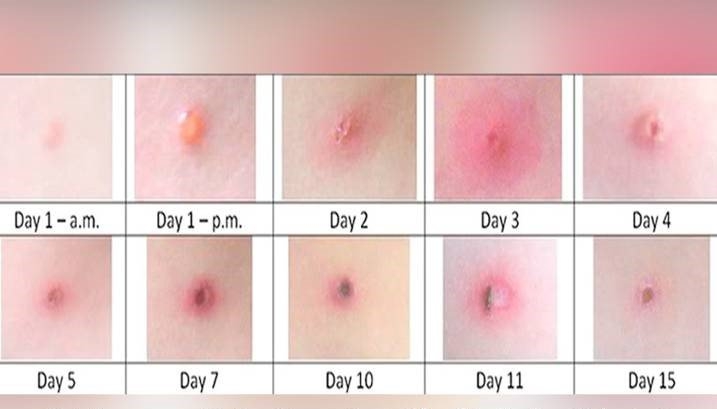 Công bố hình ảnh bóng nước ở bệnh nhân mắc đậu mùa khỉ giúp phân biệt với thủy đậu, chân tay miệng - Ảnh 4. Công bố hình ảnh bóng nước ở bệnh nhân mắc đậu mùa khỉ giúp phân biệt với thủy đậu, chân tay miệng - Ảnh 4.