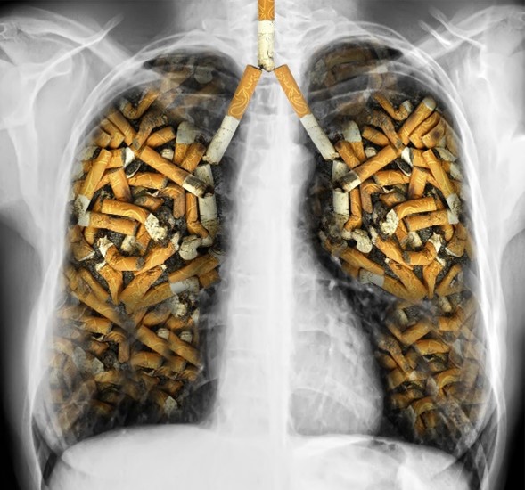 Bệnh viện K hướng dẫn công thức xác định nhóm nguy cơ cao mắc ung thư phổi - Ảnh 1.