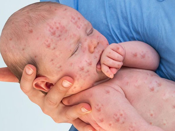 Các triệu chứng và cách điều trị bệnh sởi ở trẻ em - Ảnh 1. Các triệu chứng và cách điều trị bệnh sởi ở trẻ em Afamily