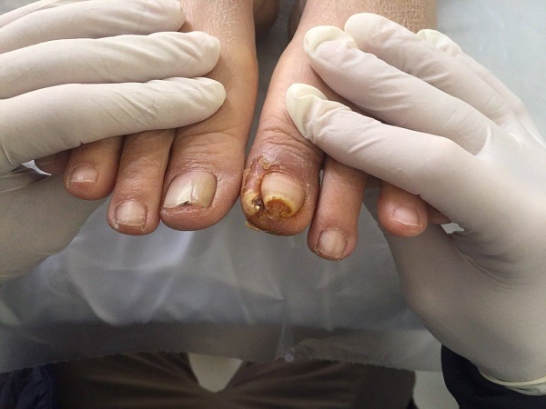 Cứ 30 giây trên thế giới lại có người bị cắt cụt chi vì biến chứng tiểu đường: Thấy chân có 1 trong 7 dấu hiệu QUEN THUỘC này phải đi khám ngay!  - Ảnh 2.