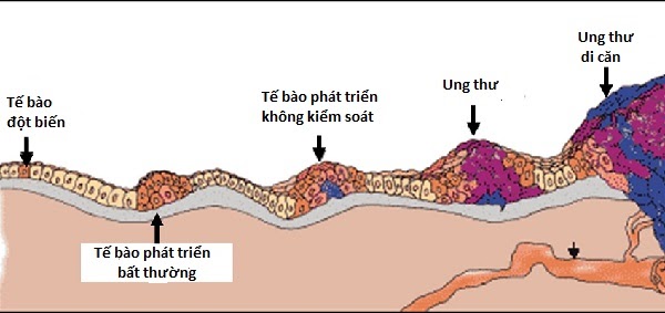 Cô gái 27 tuổi phát hiện ung thư phổi ác tính: Không hút thuốc, không uống rượu, cứ ngỡ mình sống lành mạnh nhưng cuối cùng phải cắt bỏ cả thùy phổi - Ảnh 1. Cô gái 27 tuổi phát hiện ung thư phổi ác tính: Không hút thuốc, không uống rượu, cứ ngỡ mình sống lành mạnh nhưng cuối cùng phải cắt bỏ cả thùy phổi - Ảnh 1.
