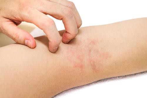 Crazy itchy skin, maybe you have one of the following serious diseases - Photo 1.
