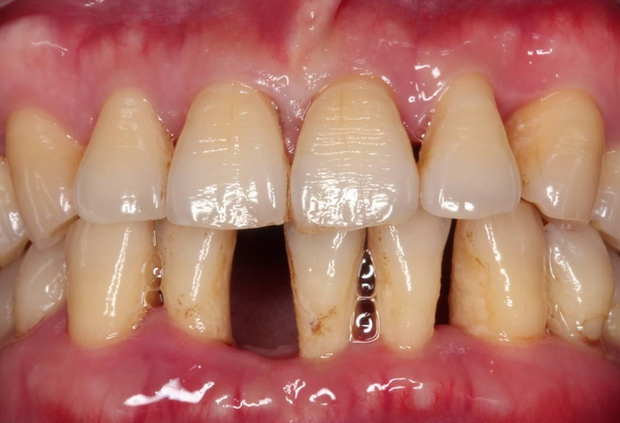 3 unusual phenomena in the oral region can help you diagnose the risk of liver cancer early - Photo 3.