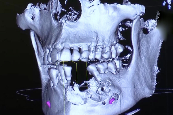 3 CLASSIC symptoms of jaw bone tumor - The disease that caused Long Chun to deform his face - Photo 3.