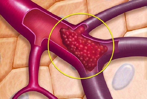 Những thực phẩm ‘dọn rác’ cho mạch máu, ăn thường xuyên có thể ngừa đột quỵ - Ảnh 1.