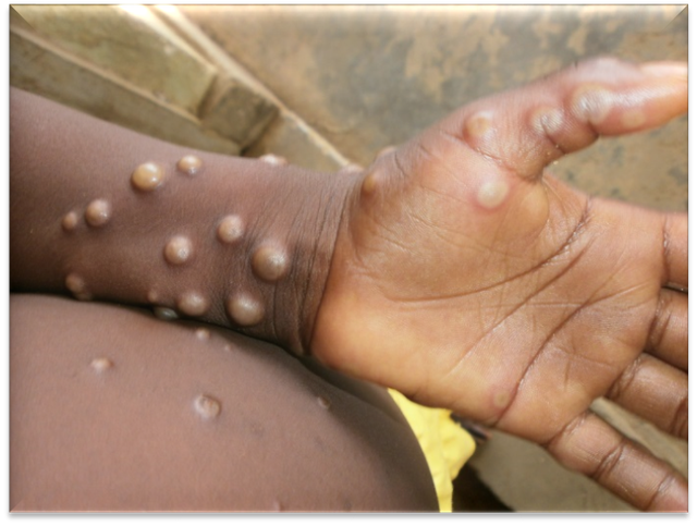 Canada confirmed the first two cases of monkeypox - Photo 1.