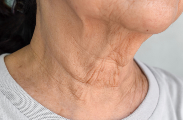   3 types of wrinkles appear on the face, indicating that blood circulation is not good, the risk of heart attack can 