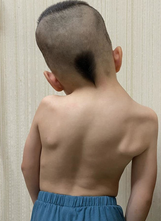  Bé trai 6 tuổi bị biến dạng vẹo lệch cột sống - lời cảnh báo cho các bậc cha mẹ  - Ảnh 1.