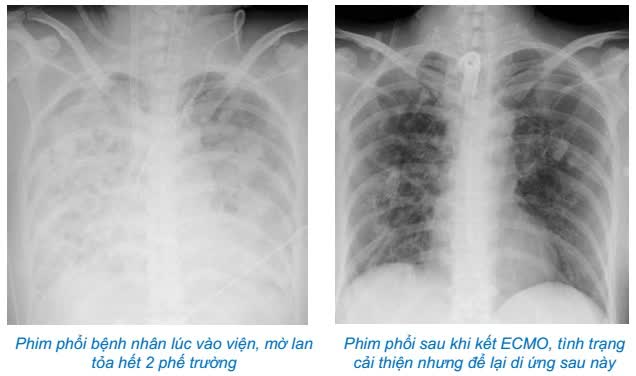 Lạm dụng thuốc điều trị cúm tại nhà, người phụ nữ bị suy đa tạng, phải chạy máy thở ECMO suốt 37 ngày - Ảnh 2.