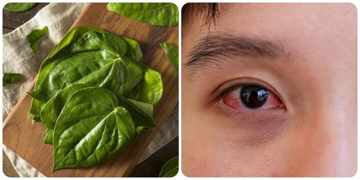 Chữa đau mắt đỏ bằng lá trầu không có thực sự hiệu quả? - Ảnh 1.