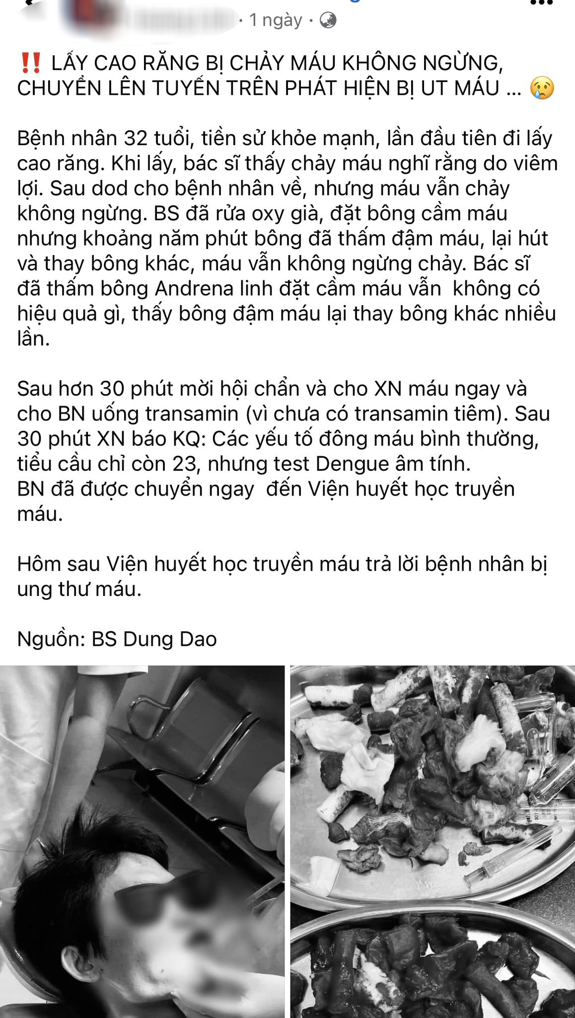 Lần đầu đi lấy cao răng bị chảy máu ồ ạt, bệnh nhân không ngờ bị ung thư máu- Ảnh 1. Lần đầu đi lấy cao răng bị chảy máu ồ ạt, bệnh nhân không ngờ bị ung thư máu- Ảnh 1.